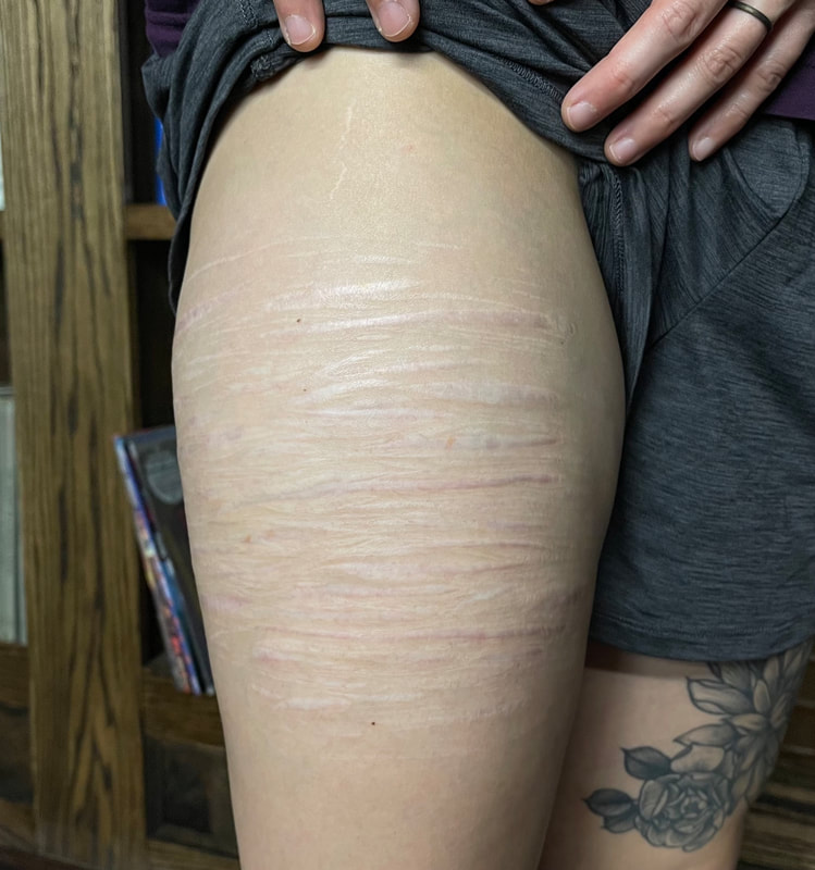 Right thigh - before